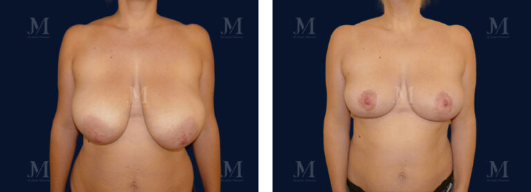 Avant / après réduction mammaire vue de face