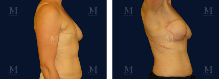 Reconstruction mammaire par le Dr Jean Masson à paris